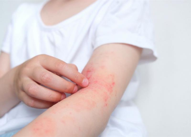 Impetigo: infecção contagiosa que provoca manchas na pele