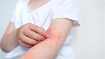 Impetigo: infecção contagiosa que provoca manchas na pele
